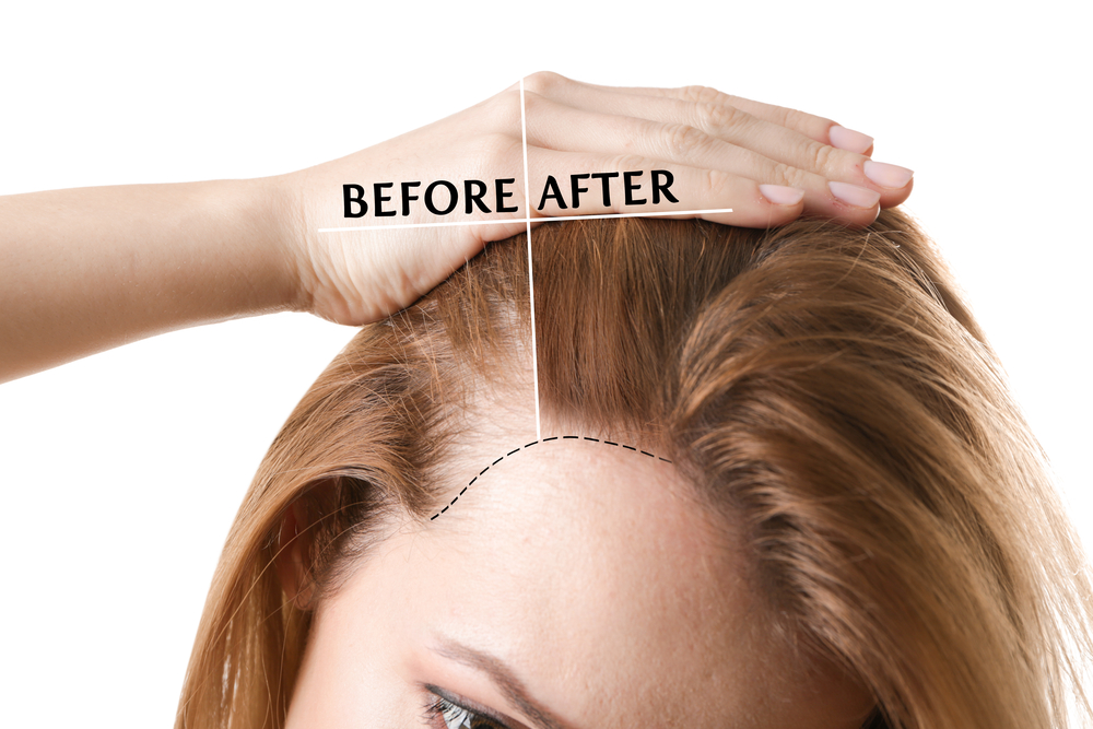 hair restoration with prp NYC